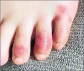  ?? NORTHWESTE­RN UNIVERSITY ?? Discolorat­ion on a teenage patient’s toes at the onset of the condition informally called “COVID toes.”