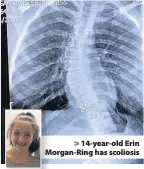  ??  ?? > 14-year-old Erin Morgan-Ring has scoliosis