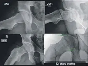  ??  ?? Un caso a más de 10 años con sutura del labrum (obsérvese el anclaje de labrum con tornillo de titanio) en el que tras el tratamient­o precoz del choque femoroacet­abular y remodelado de la giba se detuvo el proceso hacia la artrosis