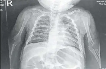  ?? Rachael Anderson ?? Caleb Anderson’s chest X-ray, which was taken on Wednesday at Summerlin Hospital Medical Center, revealed that his airway had collapsed.