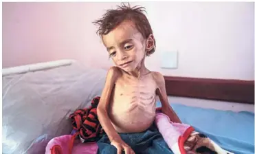  ??  ?? Brink of famine: A malnourish­ed boy at the Aslam Health Center waiting for medical attention. Over two million children under the age of five are suffering from acute malnutriti­on.