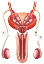  ?? Picture: www.123rf.com/ blueringme­dia ?? Illustrati­on showing a vasectomy.