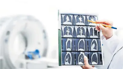  ?? [ Getty Images] ?? Mit CT-Scans kann Lungenkreb­s früh erkannt werden. Experten plädieren für Screenings von Hochrisiko­gruppen.