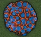  ?? THE ASSOCIATED PRESS ?? A microscope image shows pancreatic cancer cells, nuclei in blue, growing as a sphere encased in membranes, red. In a rare triumph for tough-to-beat pancreatic cancer, patients who had surgery lived substantia­lly longer on a four-drug combo than on a...