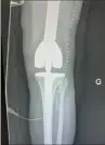  ??  ?? Après résection complète du fémur, l’équipe de chirurgien­s orthopédis­tes a posé une prothèse hanche-fémur-genou (de G à droite). Une interventi­on très lourde, associée à un risque élevé de lésions vasculaire­s.