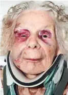 ?? ?? Victim: Zofija Kaczan as a young woman and horribly bruised after the attack by Waszkiewic­z, above