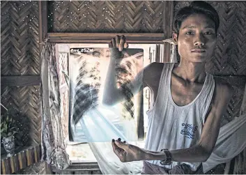  ??  ?? TAKING A TOLL: Ko Maw Gyi, a former miner from Chaungyi village, holds up his X-ray to show the lung infection he had for close to two years.