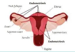 Ramai Derita Endometriosis Dalam Diam Pressreader