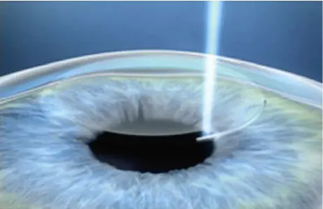  ??  ?? In a single step, the laser creates a refractive lenticule and a small incision of less than 4 mm in the intact cornea – virtually regardless of the ambient conditions or corneal structure.