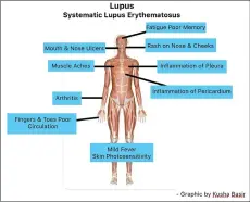  ?? ?? Lupus is a chronic autoimmune disease when your body’s immune system attacks your own body tissues including internal organs, which further causes organ failure and damage.