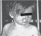  ?? CDC ?? Child with a measles rash after four days.
