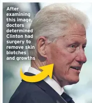  ??  ?? After examining this image, doctors determined Clinton had surgery to remove skin blotches and growths