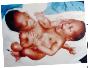  ?? ?? Conjoined: Hassan and Hussein Salih, aged one day, before the surgery that separated them