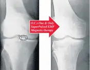  ??  ?? O.C.s One & Only SuperPulse­d EMF Magnetic therapy
Nadira Azeez: 60 Year Old Female. The following x-ray, taken after a series of Pulsed Electro-Magnetic Field Therapies, clearly shows the improved space between the knee joint, which has enabled her to...