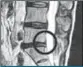  ??  ?? AFTER MRI images of herniated disk before and after our treatment.