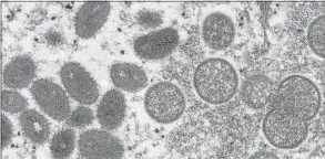  ?? Centers for Disease Control and Prevention via Associated Press file photo ?? This 2003 electron microscope image made available by the Centers for Disease Control and Prevention shows mature, oval-shaped monkeypox virions, left, and spherical immature virions, right, obtained from a sample of human skin associated with the 2003 prairie dog outbreak. The Biden administra­tion has started shipping testing kits for monkeypox to commercial laboratori­es, in a bid to speed diagnostic tests for suspected infections of the virus that has infected at least 142 people in the U.S.