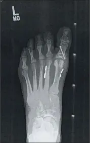  ??  ?? An X-ray shows how the “mini-tightrope” surgery for bunions helped realign Frame’s foot.