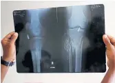  ??  ?? BONE TO PICK: A bullet shown in the X-ray of a Rohingya at a Bangladesh hospital. Authoritie­s blame insurgents for the violence in Rakhine.