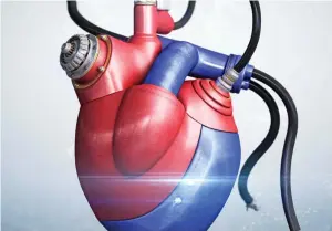  ??  ?? LEAKY heart valves can leave patients struggling for breath and lead to heart failure. Repair usually involves open heart surgery but Michael Hammond, 66, an architectu­ral website editor, underwent a world-first procedure to treat it, as he tells CAROL DAVIS.