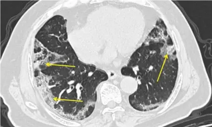  ?? Photograph: Mount Sinai Hospital/AP ?? Respirator­y physician John Wilson explains the range of Covid-19 impacts. This image shows a CT scan from a man with Covid-19. Pneumonia caused by the new coronaviru­s can show up as distinctiv­e hazy patches on the outer edges of the lungs, indicated by arrows.