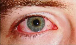  ??  ?? although conjunctiv­itis or pink eye is a very rare symptom of Covid-19, it can sometimes be the only symptom a patient has. — WIKIMedIa COMMOnS