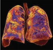  ??  ?? A CT scan of lungs affected by Covid-19