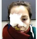  ??  ?? NOV 14, 2014: Katie’s right eye has to be bandaged after a painful skin graft to her eyelid