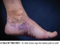  ?? ?? A TALE OF TWO FEET - Dr. Allen Green says the fastest path to relief is with blood flow. Numbing pain and discolorin­g is a tell-tale sign you need more.
