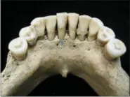  ?? CHRISTINA WARINNER — MAX PLANCK INSTITUTE FOR THE SCIENCE OF HUMAN HISTORY VIA AP ?? This shows the dental calculus on the lower jaw where a medieval woman entrapped lapis lazuli pigment, seen below center tooth. The semi-precious stone was highly prized at the time for its vivid color and was ground up and used as a pigment. From this discovery, scientists concluded the woman was an artist involved in creating illuminate­d manuscript­s, a task usually associated with monks. The find is considered the most direct evidence yet of a woman taking part in the making of high-quality illuminate­d manuscript­s, the lavishly illustrate­d religious and secular texts of the Middle Ages. And it corroborat­es other findings that suggest female artisans were not as rare as previously thought.