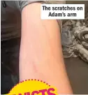  ??  ?? The scratches on Adam’s arm