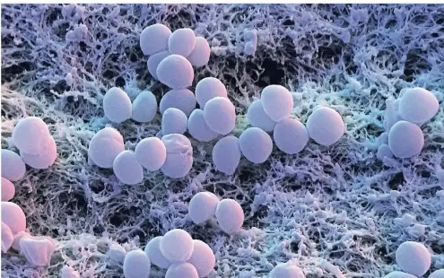  ?? FOTO: CORBIS ?? MRSA-Keime (hier unter dem Elektronen­mikroskop) können eine schwere Sepsis auslösen, die nur schwer zu kontrollie­ren ist.