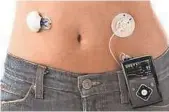  ?? MEDTRONIC ?? Medtronic says its MiniMed 670G is the world’s first hybrid closed-loop insulin delivery system.