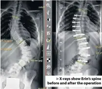  ??  ?? > X-rays show Erin’s spine before and after the operation