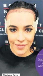  ??  ?? Stephanie Davis during her hair transplant procedure