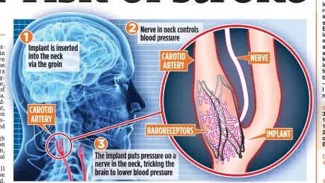  ??  ?? PRESSURE POINT: The implant is positioned to stimulate the barorecept­ors which detect changes in blood pressure