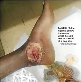  ?? Picture: SUPPLIED ?? PAINFUL: Xolile Ngumla shows the wound which he said was as a result of a dog bite