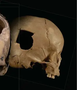  ??  ?? Evidence of trepanatio­n can be seen on these ancient Peruvian skulls. If the bone around the surgical hole shows no signs of healing, researcher­s know the patient died either during or shortly after the surgery