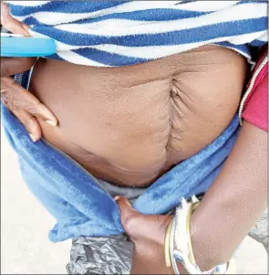  ?? (Pics: Nonduduzo Kunene) ?? How Samkelisiw­e Matsebula’s stomach looks after the four operations.