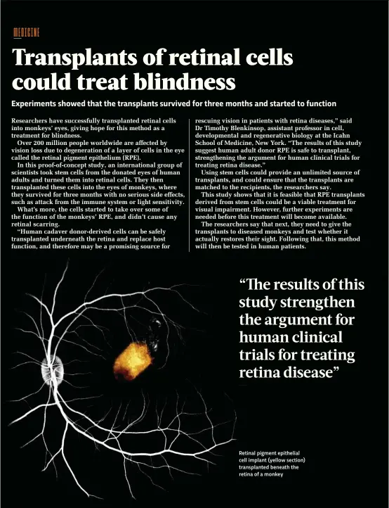  ??  ?? Retinal pigment epithelial cell implant (yellow section) transplant­ed beneath the retina of a monkey