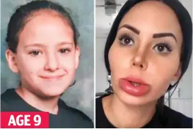  ??  ?? AGE 9 Changed: Star Delguidice as a child and after a lip op went wrong