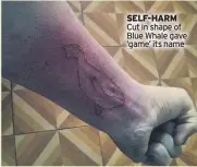  ??  ?? SELF-HARM Cut in shape of Blue Whale gave ‘game’ its name