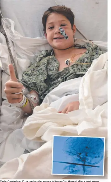  ?? Picture: AFP/SHANNON MILLER ?? Xavier Cunningham, 10, recovering after surgery in Kansas City, Missouri, after a meat skewer impaled his skull but missed his brain and spinal cord.