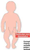  ?? (Infog Rina Uzan) ?? L’ectopie testiculai­re augmente les risques de cancer du testicule. Il est conseillé à tous les hommes de s’autopalper et de consulter à la moindre anomalie.