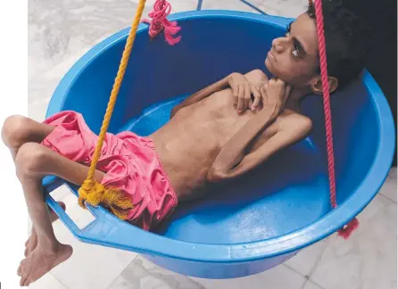  ?? ?? A Yemeni child suffering from severe malnutriti­on is weighed at a treatment centre. Picture: Essa Ahmed