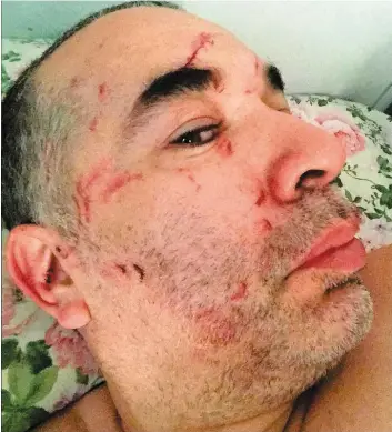  ?? PHOTO COURTOISIE, TVA NOUVELLES ?? Les traces laissées par l’agression sur le chauffeur d’autobus de la STM Samir Hajjami.
