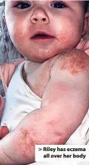  ?? ?? > Riley has eczema all over her body