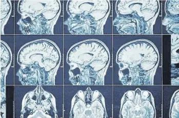  ?? EUROPA PRESS ?? El glioblasto­ma es el tipo de cáncer cerebral más agresivo.