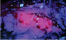  ??  ?? EASY TO SPOT: An area of brain tumour glows due to the Gliolan drink