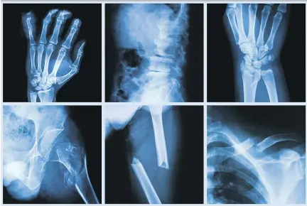 ?? GETTY IMAGES ?? Orthopedic clinics see patients several times to follow up on treatment or to remove casts. This makes them well-suited to serve as safe places for victims of abuse, according to the Canadian Orthopedic Associatio­n. The COA wants physicians to...