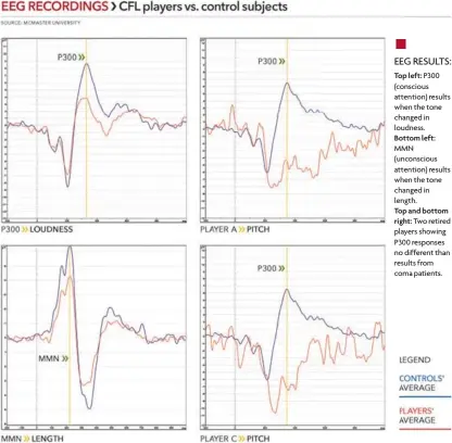  ??  ?? EEG RESULTS: Top left: P300 (conscious attention) results when the tone changed in loudness. Bottom left: MMN (unconsciou­s attention) results when the tone changed in length. Top and bottom
right: Two retired players showing P300 responses no...